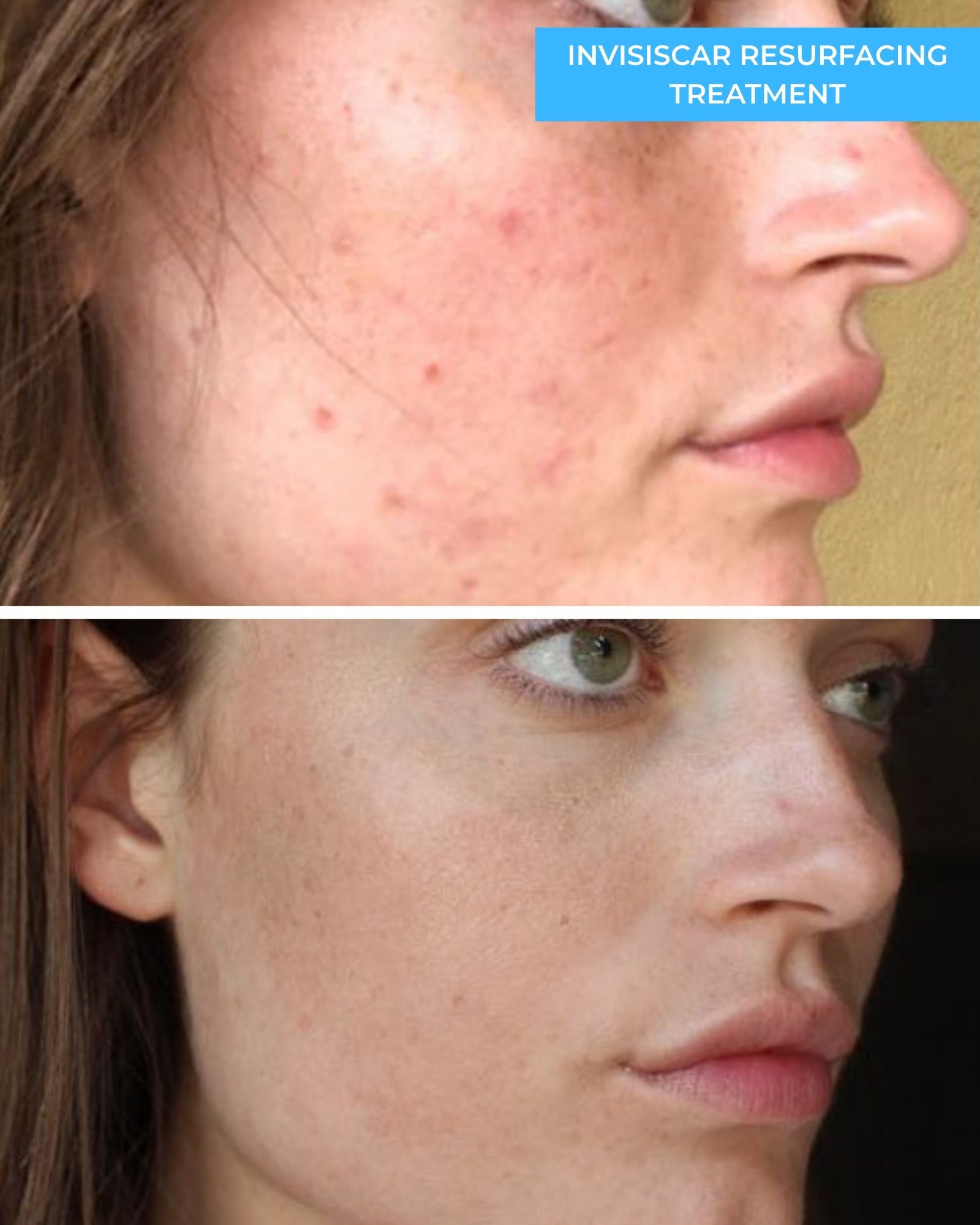 InvisiScar Resurfacing Treatment