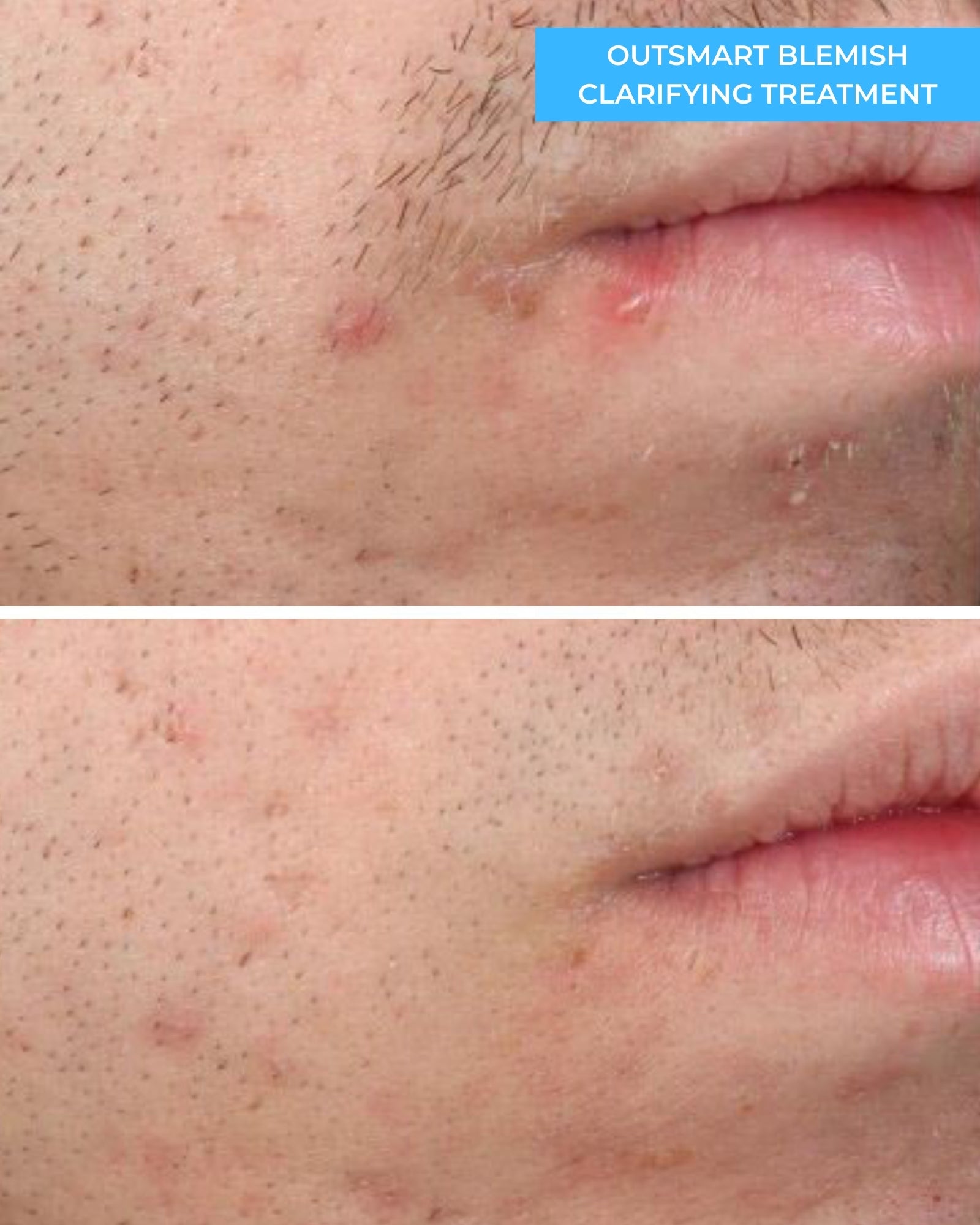 Outsmart Blemish Clarifying Treatment