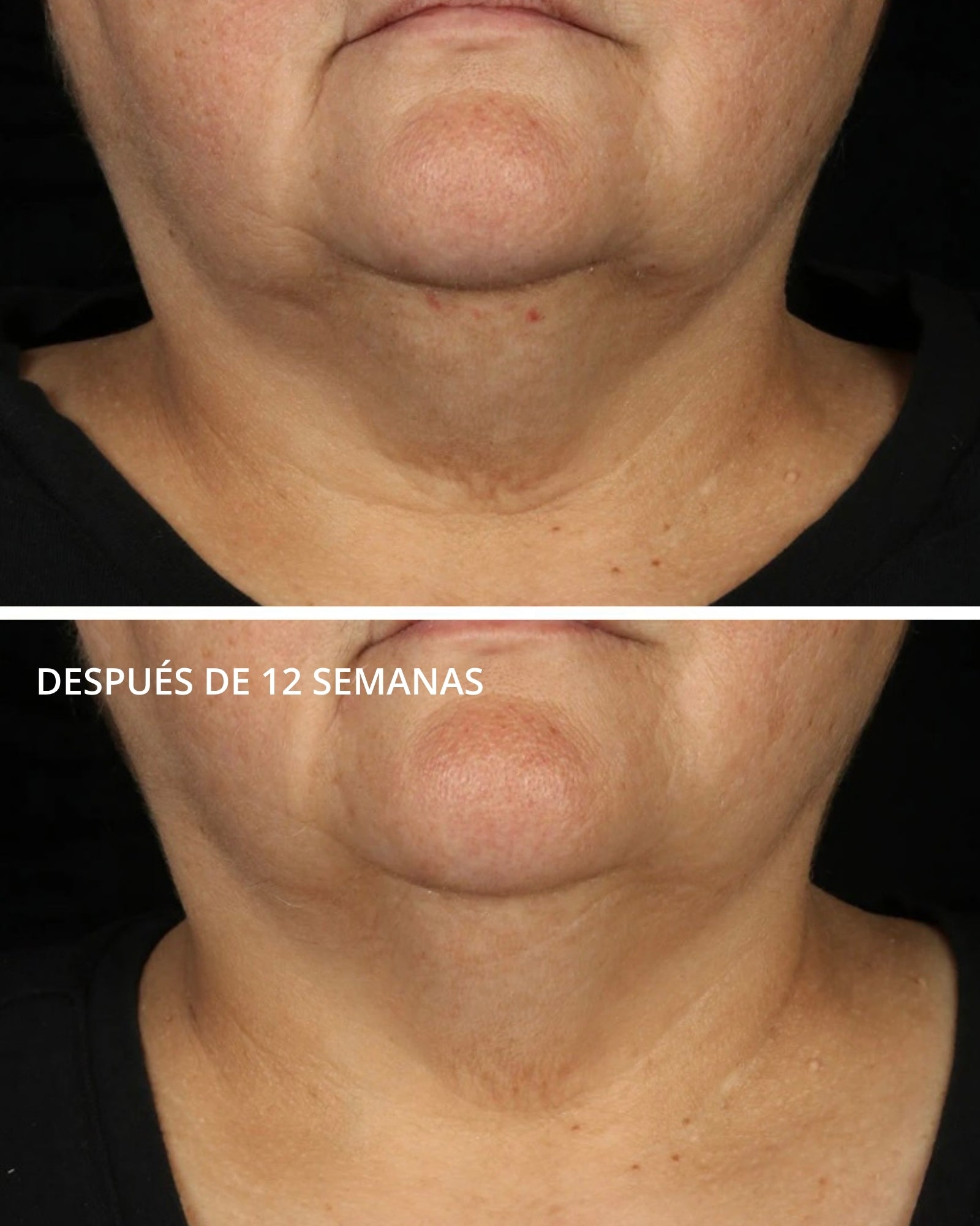 Tri-Therapy Lifting Serum con MicroDiPéptido229® Neostrata