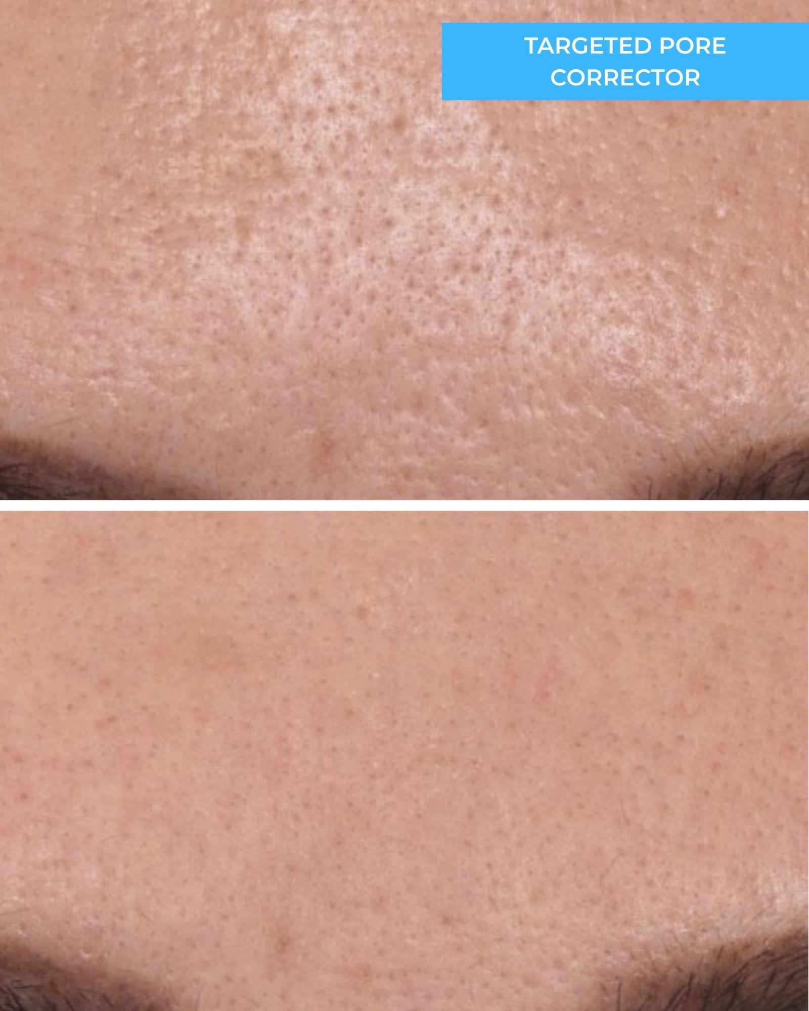 Targeted Pore Corrector