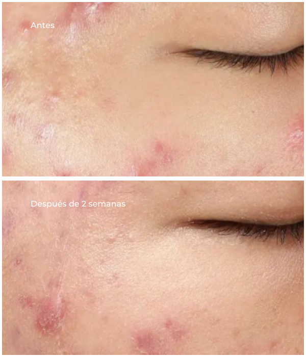 Deep Relief Blemish Treatment