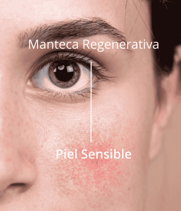 Manteca Regenerativa Piel Sensible, Rosacea. Newen