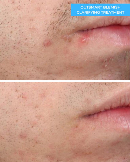 Outsmart Blemish Clarifying Treatment