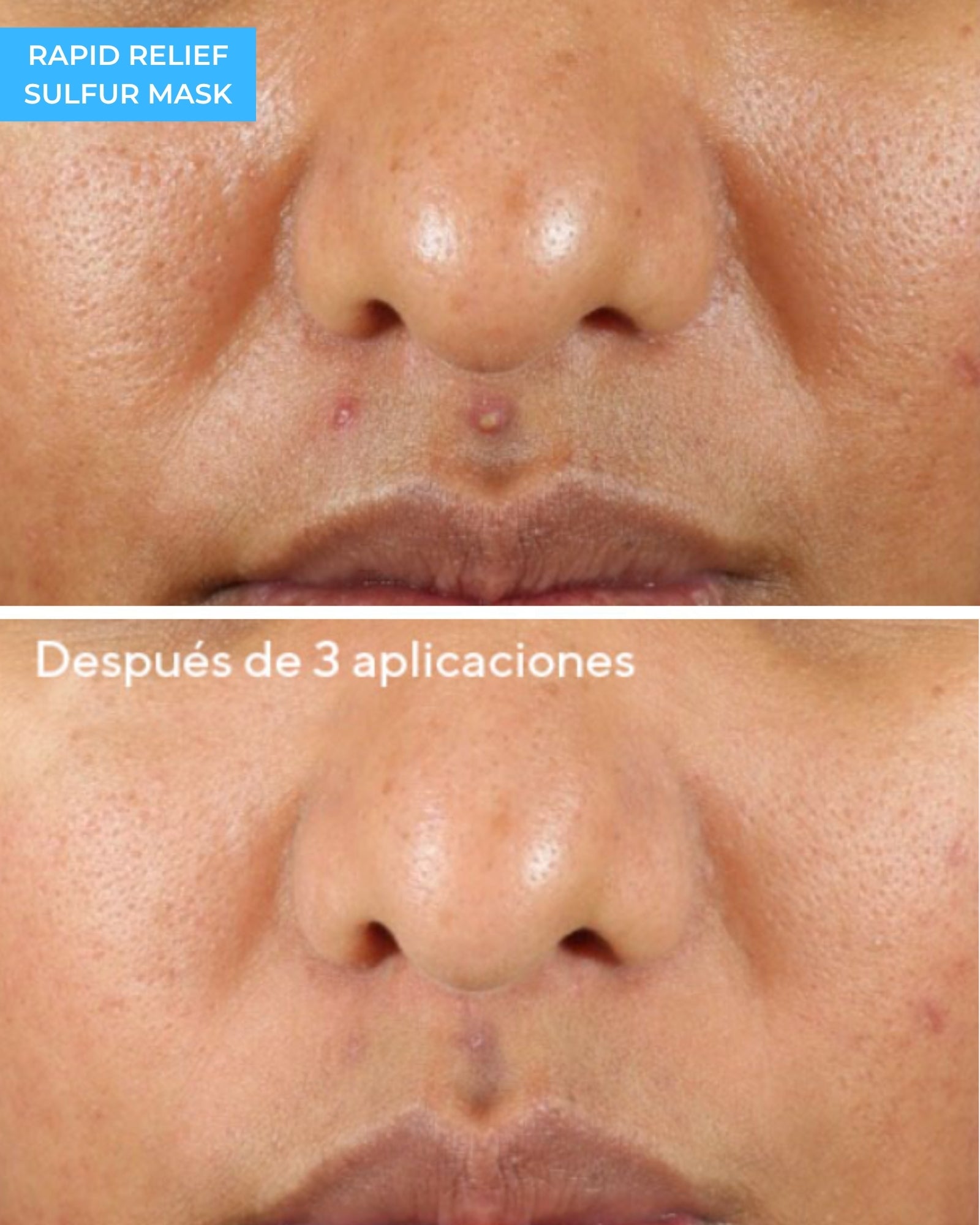 Rapid Relief Sulfur Mask