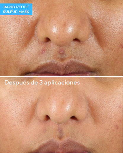 Rapid Relief Sulfur Mask