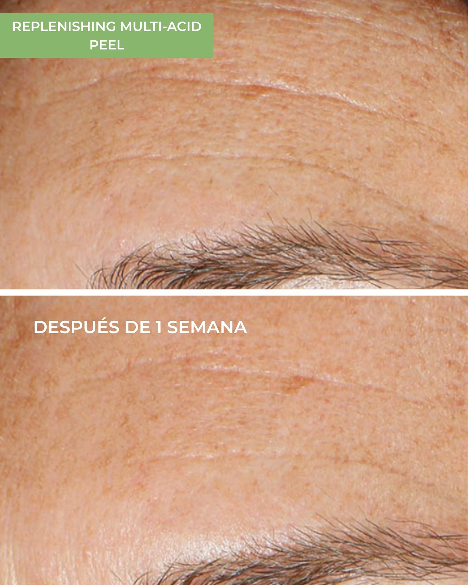 Replenishing Multi-Acid Peel