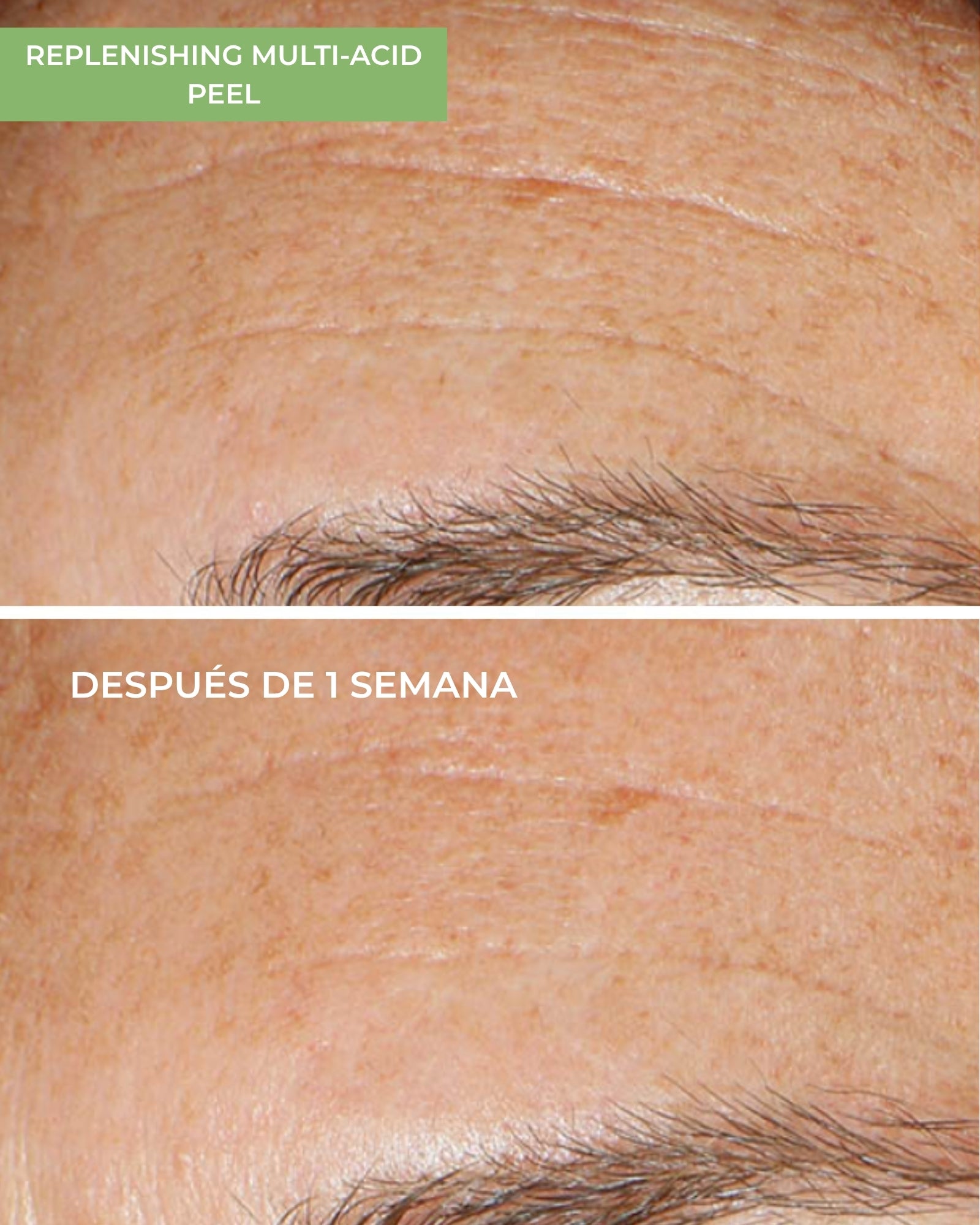 Replenishing Multi-Acid Peel