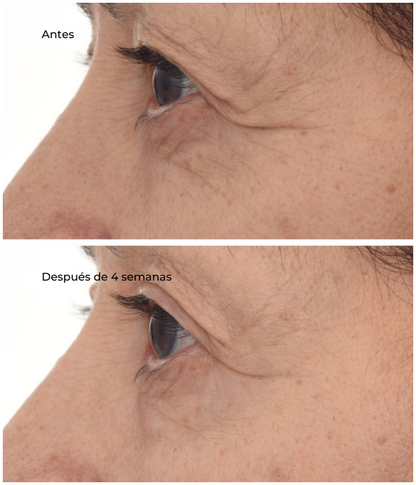 Retinal ReSculpt™ Eye Lift Treatment