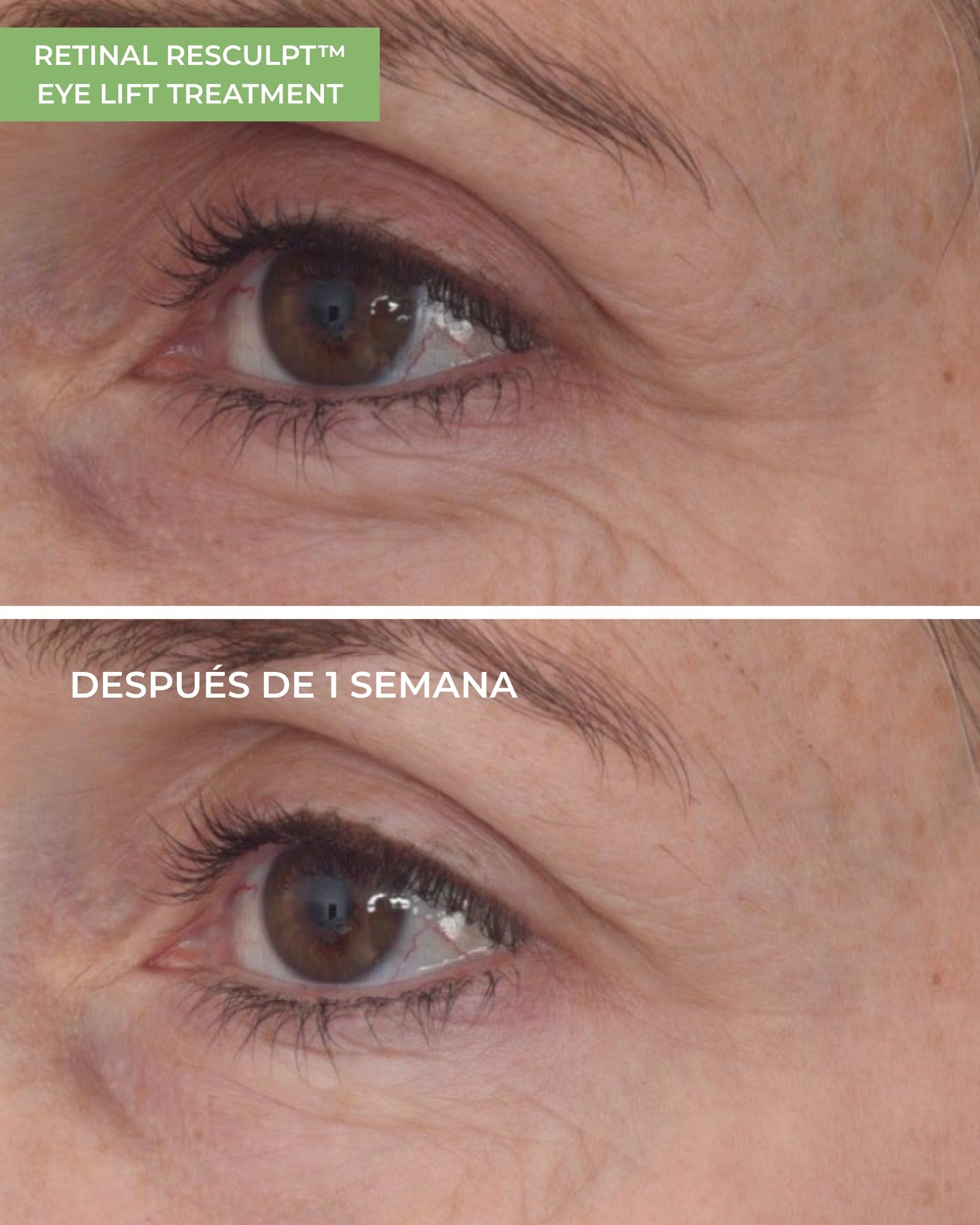 Retinal ReSculpt™ Eye Lift Treatment