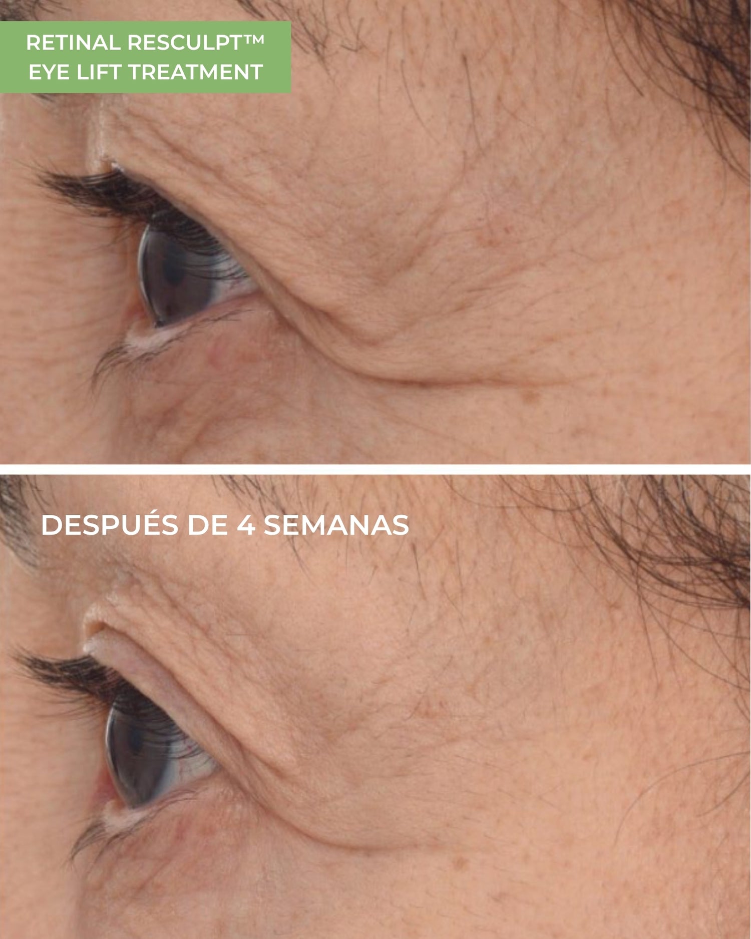 Retinal ReSculpt™ Eye Lift Treatment