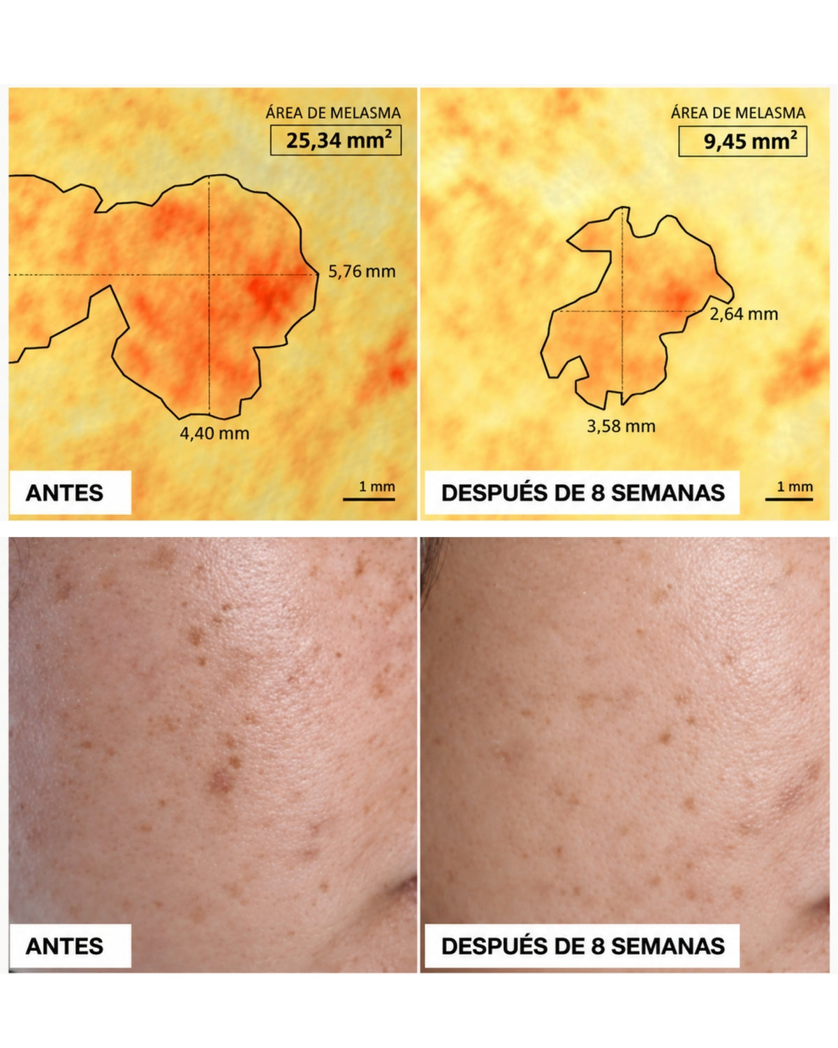 TXA Anti-Dark Spots Concentrate Despigmentante 1 Frasco x 10 ml DermEden