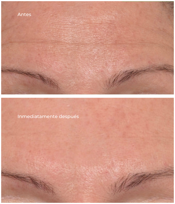 Targeted Wrinkle Corrector